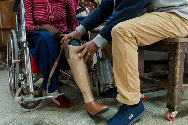 Beinprothese anpassen bei einer Leprapatientin