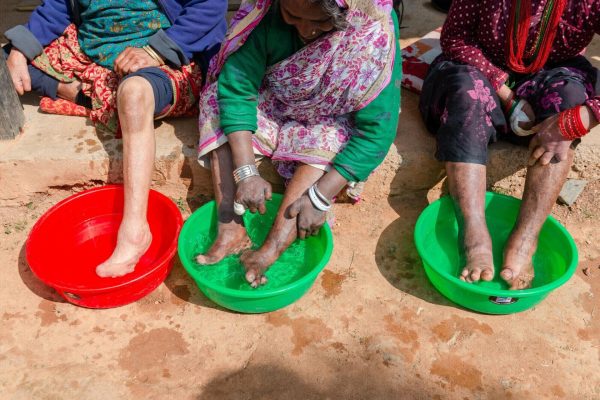 The self-care unit at Anandaban Hospital is a place where patients can learn new techniques which will help them to adapt to every day tasks at home. They may have had surgery to correct their hands or other services at Anandaban. It is specifically for those affected by leprosy, aimed at helping them cope with a lack of sensation. 

Staff demonstrate self-care techniques such as foot soaking and self-care in order to prevent cracks and ulcers. They also practise adapting tools to that are used for everyday tasks, such as digging the land or cooking food. These techniques help to protect numb hands and feet from injury, help prevent ulcers and reduce hospital admissions.
