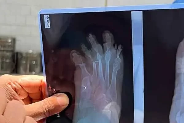 Radiographie d'un patient de l'hôpital de Mission Lèpre à Purulia.
